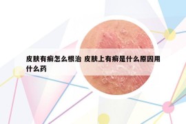 皮肤有癣怎么根治 皮肤上有癣是什么原因用什么药