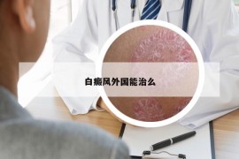 白癜风外国能治么