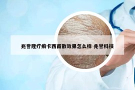 兆誉隆疗癣卡西甫散效果怎么样 兆誉科技