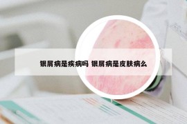 银屑病是疾病吗 银屑病是皮肤病么