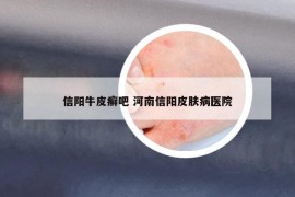 信阳牛皮癣吧 河南信阳皮肤病医院