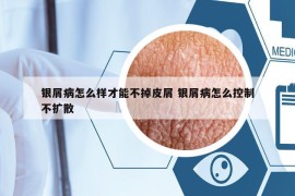 银屑病怎么样才能不掉皮屑 银屑病怎么控制不扩散