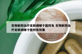 生物制剂治疗皮肤病哪个医院有 生物制剂治疗皮肤病哪个医院有效果