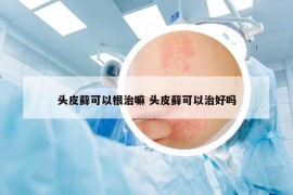 头皮藓可以根治嘛 头皮藓可以治好吗