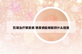 饥饿治疗银屑病 银屑病能缓解到什么程度