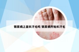 银屑病上面长汗毛吗 银屑病开始长汗毛