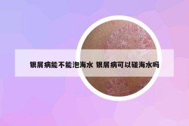 银屑病能不能泡海水 银屑病可以碰海水吗