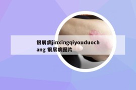 银屑病jinxingqiyouduochang 银屑病图片