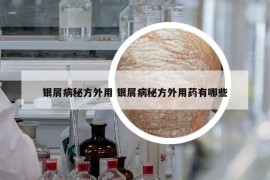 银屑病秘方外用 银屑病秘方外用药有哪些