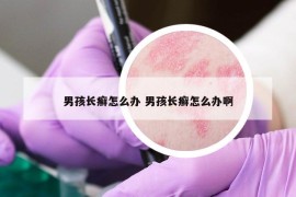 男孩长癣怎么办 男孩长癣怎么办啊