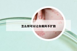 怎么样可以让白癜风不扩散