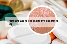 银屑病关节炎口干吗 银屑病关节炎需要忌口吗