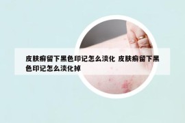 皮肤癣留下黑色印记怎么淡化 皮肤癣留下黑色印记怎么淡化掉