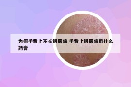 为何手背上不长银屑病 手背上银屑病用什么药膏