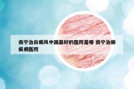 南宁治白癜风中国最好的医院是哪 南宁治癫疯病医院