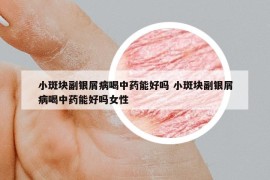 小斑块副银屑病喝中药能好吗 小斑块副银屑病喝中药能好吗女性