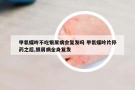 甲氨蝶呤不吃银屑病会复发吗 甲氨蝶呤片停药之后,银屑病全身复发