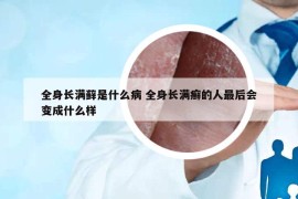 全身长满藓是什么病 全身长满癣的人最后会变成什么样