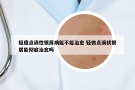 轻度点滴性银屑病能不能治愈 轻微点滴状银屑能彻底治愈吗