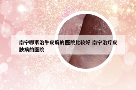 南宁哪家治牛皮癣的医院比较好 南宁治疗皮肤病的医院