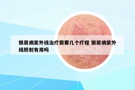 银屑病紫外线治疗需要几个疗程 银屑病紫外线照射有用吗