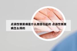 点滴性银屑病是什么原因引起的 点滴性银屑病怎么得的