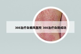 308治疗白癜风医院 308治疗白斑成功