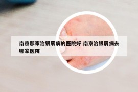 南京那家治银屑病的医院好 南京治银屑病去哪家医院