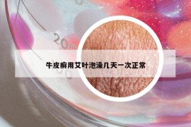 牛皮癣用艾叶泡澡几天一次正常