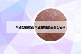 气虚型银屑病 气虚型银屑病怎么治疗