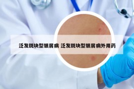 泛发斑块型银屑病 泛发斑块型银屑病外用药