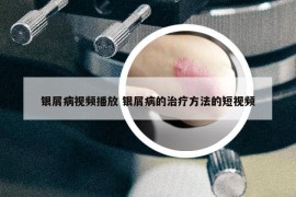 银屑病视频播放 银屑病的治疗方法的短视频