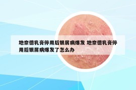 地奈德乳膏停用后银屑病爆发 地奈德乳膏停用后银屑病爆发了怎么办