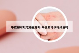 牛皮癣可以吃绿豆芽吗 牛皮廨可以吃绿豆吗