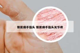 银屑病手指头 银屑病手指头关节疼