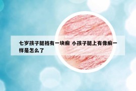 七岁孩子腿裆有一块癣 小孩子腿上有像癣一样是怎么了