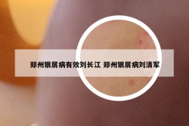 郑州银屑病有效刘长江 郑州银屑病刘清军