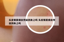 头皮银屑病会传染到身上吗 头皮银屑病会传染到身上吗