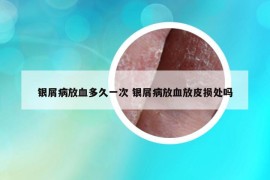 银屑病放血多久一次 银屑病放血放皮损处吗