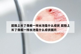 屁股上长了像癣一样水泡是什么症状 屁股上长了像癣一样水泡是什么症状图片