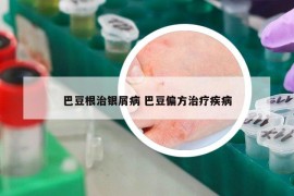 巴豆根治银屑病 巴豆偏方治疗疾病