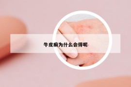 牛皮癣为什么会得呢