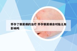 怀孕了银屑病的治疗 怀孕银屑病会对胎儿有影响吗