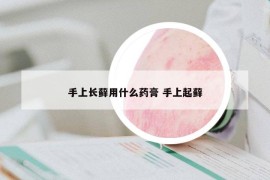 手上长藓用什么药膏 手上起藓