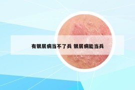 有银屑病当不了兵 银屑病能当兵