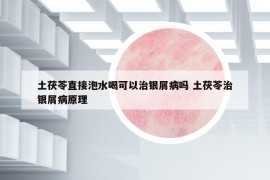 土茯苓直接泡水喝可以治银屑病吗 土茯苓治银屑病原理