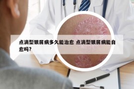 点滴型银屑病多久能治愈 点滴型银屑病能自愈吗?