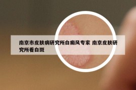 南京市皮肤病研究所白癜风专家 南京皮肤研究所看白斑