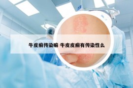 牛皮癣传染嘛 牛皮皮癣有传染性么