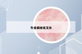 牛皮癣掉皮又长